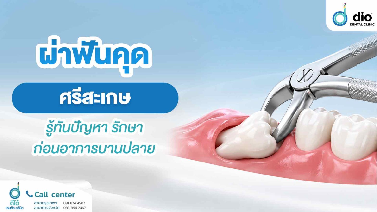 ผ่าฟันคุด ศรีสะเกษ