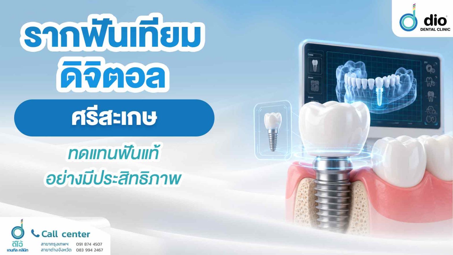 รากฟันเทียมดิจิตอล ศรีสะเกษ