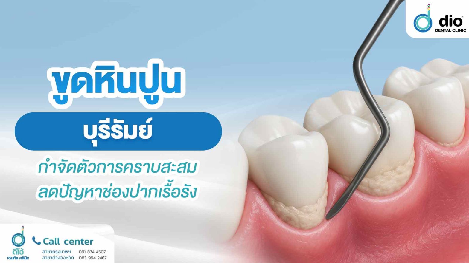 ขูดหินปูน บุรีรัมย์ กำจัดตัวการคราบสะสม ลดปัญหาช่องปากเรื้อรัง