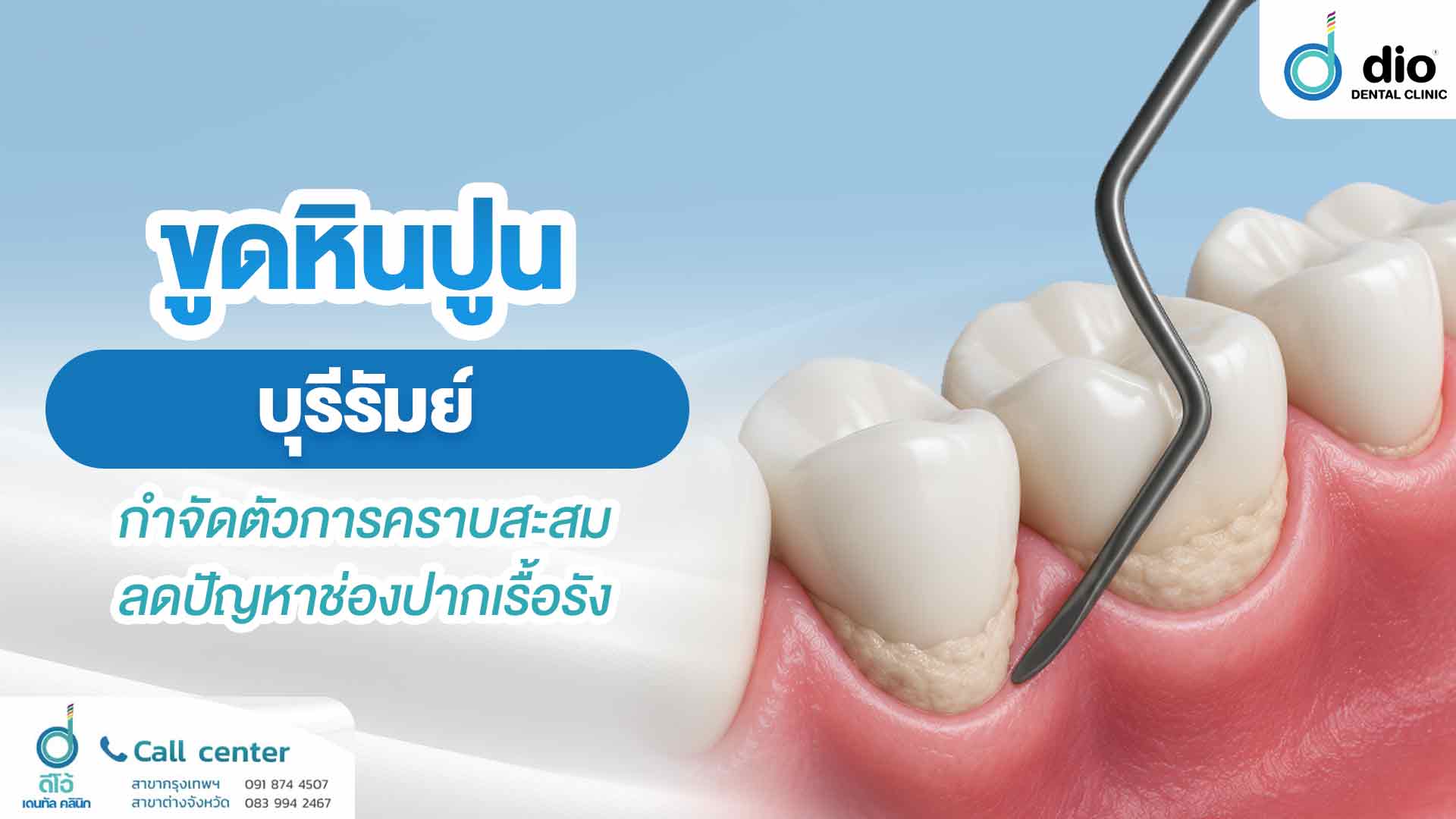 ขูดหินปูน บุรีรัมย์ กำจัดตัวการคราบสะสม ลดปัญหาช่องปากเรื้อรัง