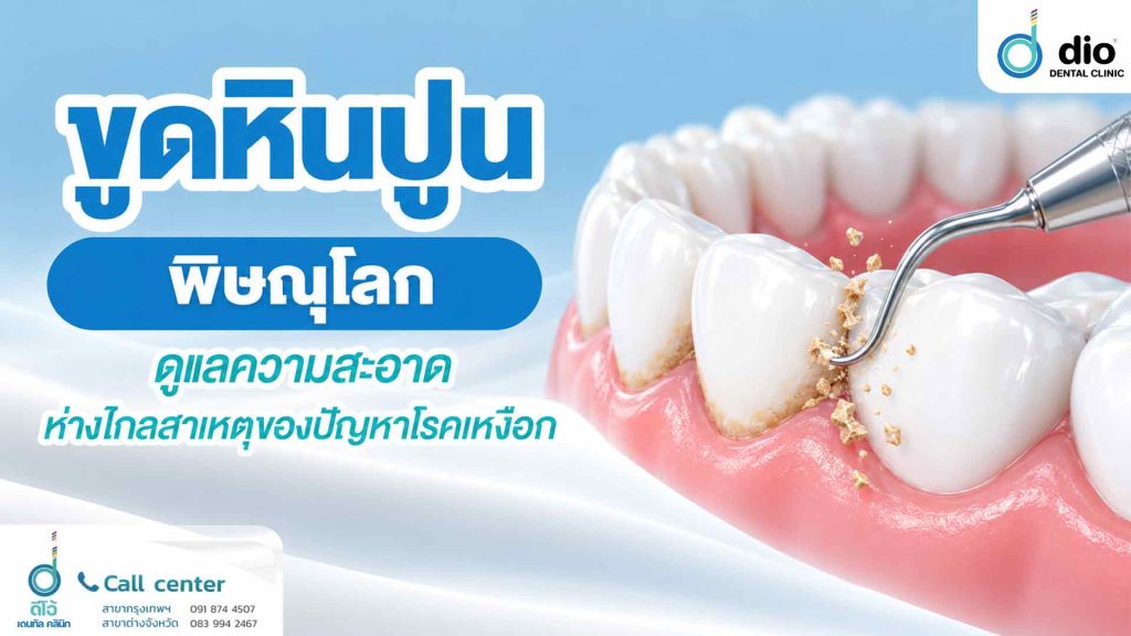ขูดหินปูน พิษณุโลก ดูแลความสะอาด ห่างไกลสาเหตุของปัญหาโรคเหงือก