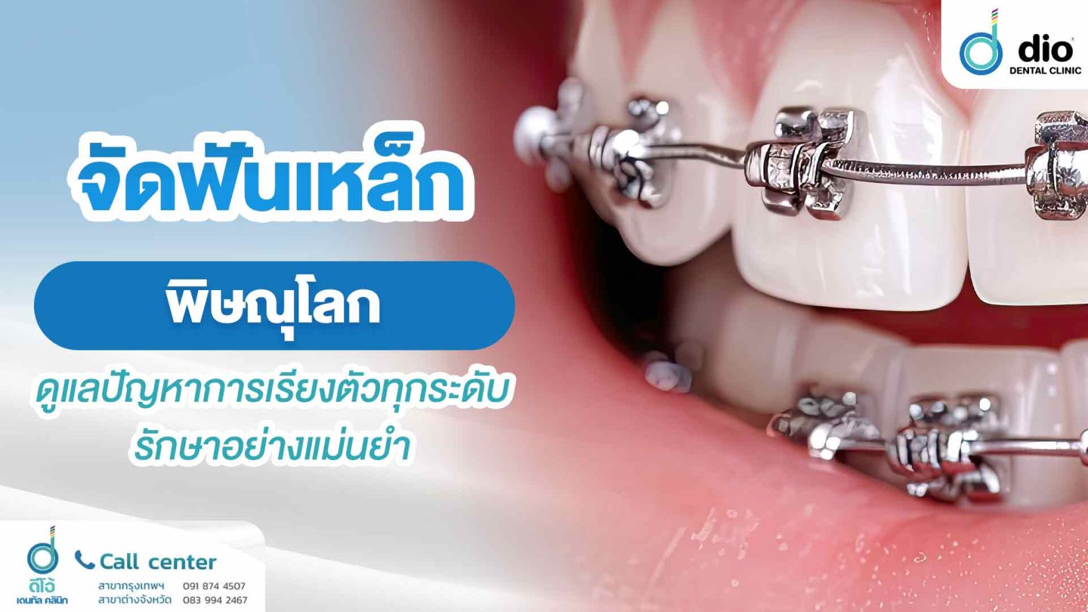 จัดฟันเหล็ก พิษณุโลก แก้ปัญหาฟันผิดรูป รักษาอย่างแม่นยำ