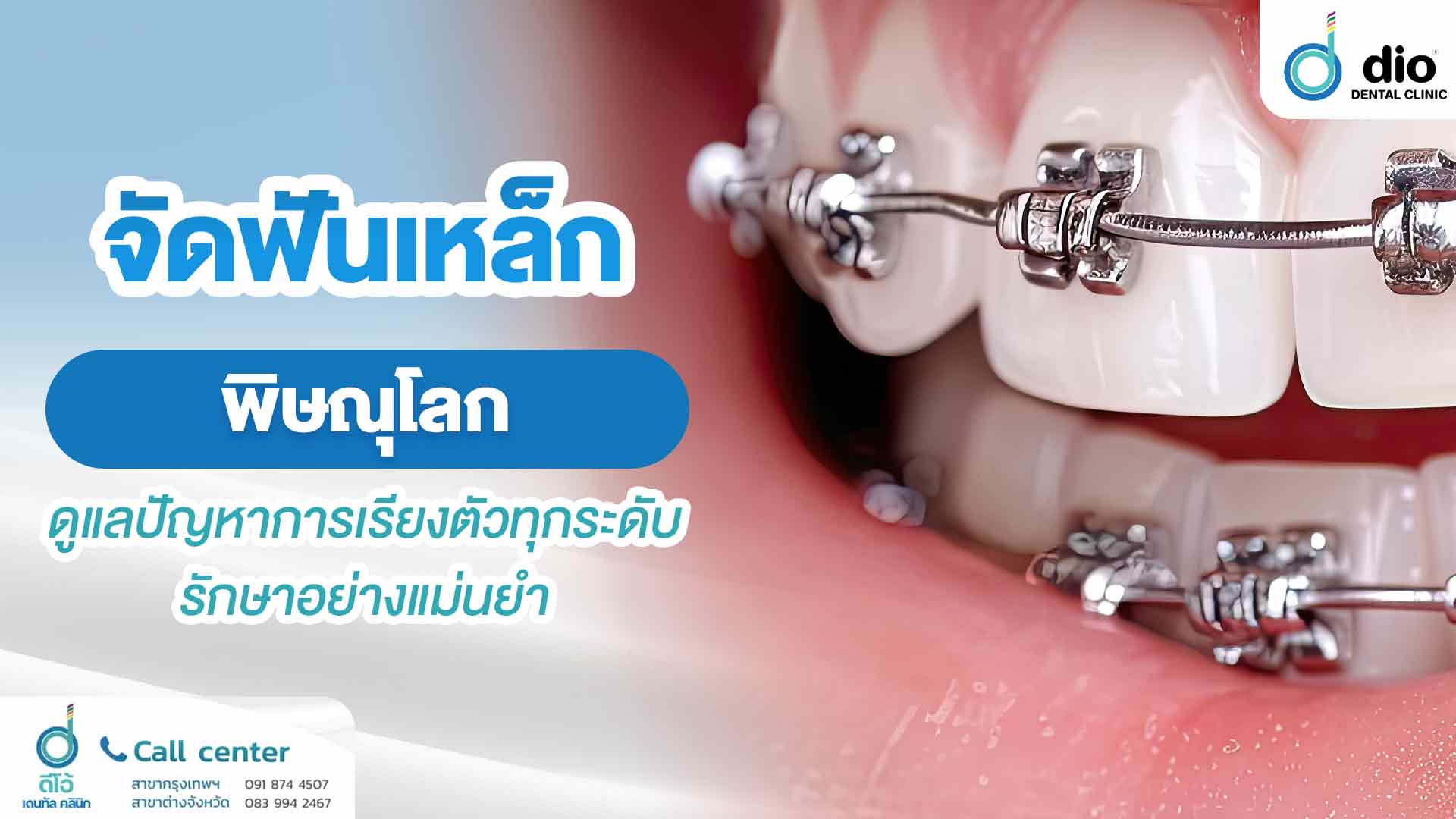 จัดฟันเหล็ก พิษณุโลก แก้ปัญหาฟันผิดรูป รักษาอย่างแม่นยำ