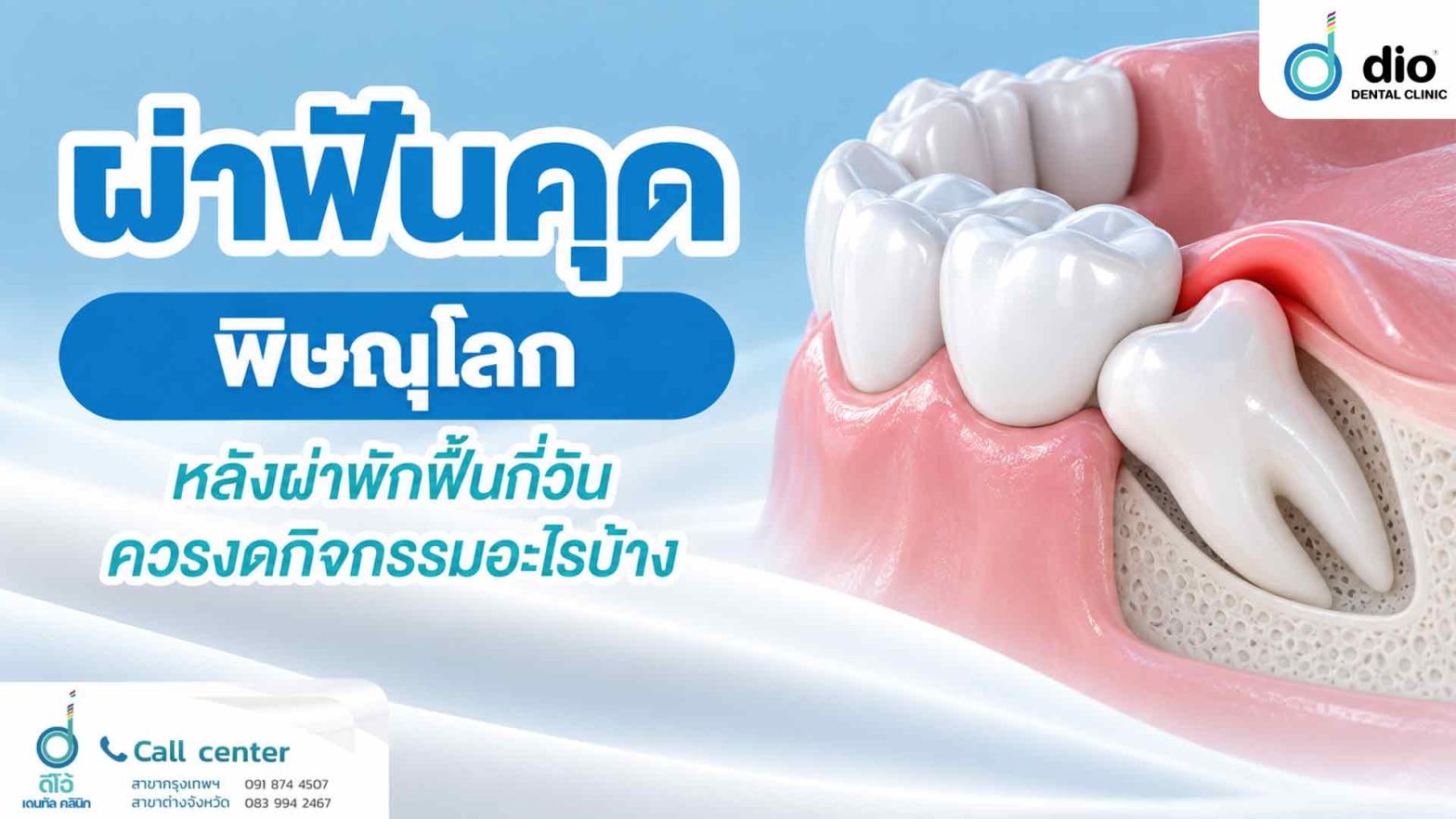 ผ่าฟันคุด พิษณุโลก หลังผ่าพักฟื้นกี่วัน ควรงดกิจกรรมอะไรบ้าง