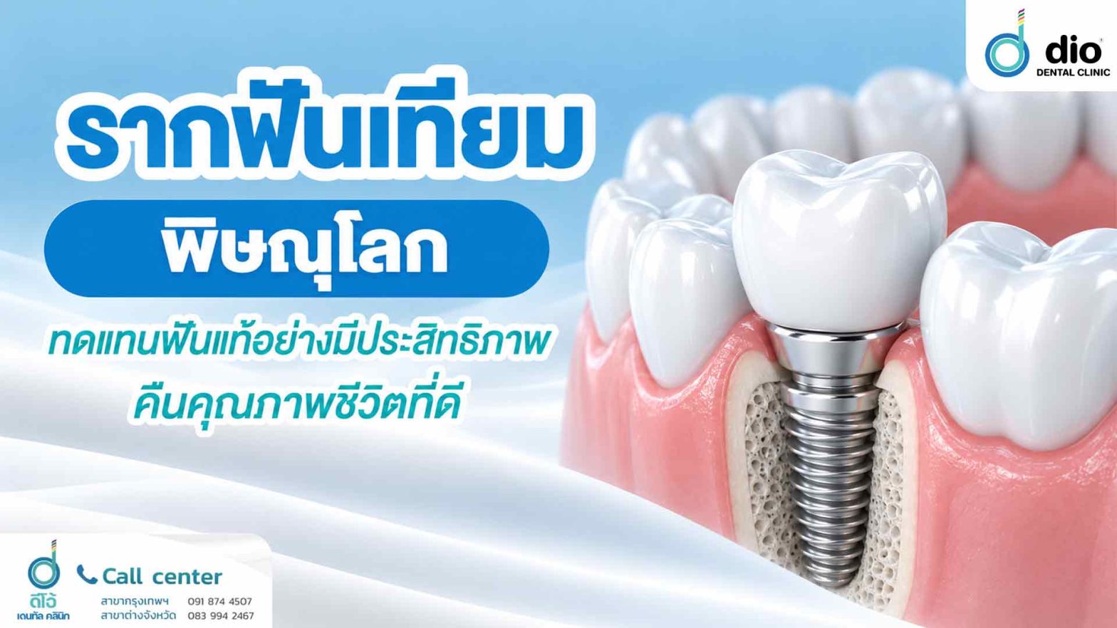 รากฟันเทียม พิษณุโลก ทดแทนฟันแท้อย่างมีประสิทธิภาพ คืนคุณภาพชีวิตที่ดี