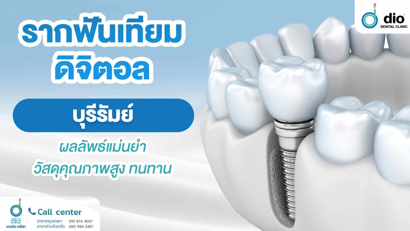 รากฟันเทียมดิจิตอล บุรีรัมย์ ผลลัพธ์แม่นยำ วัสดุคุณภาพสูง ทนทาน